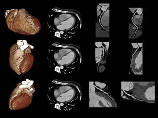 High perivascular fat attenuation index values are important markers of increased cardiac mortality. High perivascular fat attenuation index values are important markers of increased cardiac mortality.