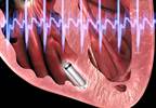 Leadless Pacemakers "Lead" the Way to Fewer Complications in Cardiac Arrhythmias Leadless Pacemakers "Lead" the Way to Fewer Complications in Cardiac Arrhythmias