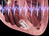 Leadless Pacemakers "Lead" the Way to Fewer Complications in Cardiac Arrhythmias Leadless Pacemakers "Lead" the Way to Fewer Complications in Cardiac Arrhythmias