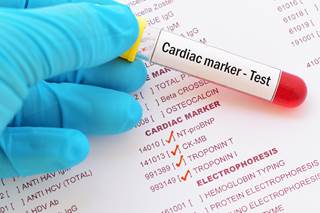Natriuretic peptides and high-sensitive troponin may be useful for cardiac risk stratification in acute syncope. Natriuretic peptides and high-sensitive troponin may be useful for cardiac risk stratification in acute syncope.