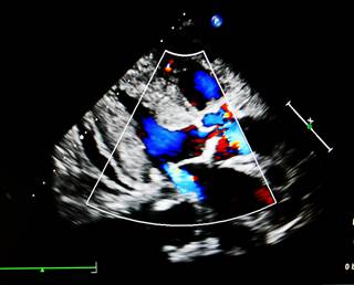 At 12 months, the rate of freedom from device-related complications was 96.6%. At 12 months, the rate of freedom from device-related complications was 96.6%.