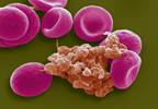 Baseline Thrombocytopenia Associated With Mortality Risk in VTE Baseline Thrombocytopenia Associated With Mortality Risk in VTE