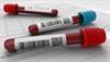 Plasma Acylcarnitines May Indicate Diabetes Risk Among Those at High Risk for CVD Plasma Acylcarnitines May Indicate Diabetes Risk Among Those at High Risk for CVD