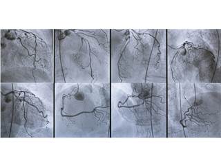 Single-stage complete coronary revascularization appears to be superior to culprit-only lesion intervention in multivessel disease ACS. Single-stage complete coronary revascularization appears to be superior to culprit-only lesion intervention in multivessel disease ACS.