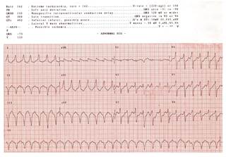 In men but not women, total occlusion of the culprit artery, stent thrombosis, a Killip class of 3 or greater, and presentation during off-hours predicted delays. In men but not women, total occlusion of the culprit artery, stent thrombosis, a Killip class of 3 or greater, and presentation during off-hours predicted delays.