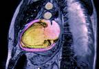 Quality of Life, Treatment Suboptimal in Women With HFrEF Quality of Life, Treatment Suboptimal in Women With HFrEF
