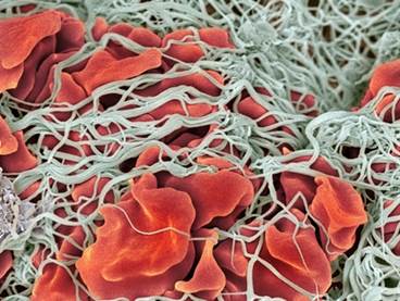 Questions Remain Regarding VTE Recurrence in Older Adults Questions Remain Regarding VTE Recurrence in Older Adults