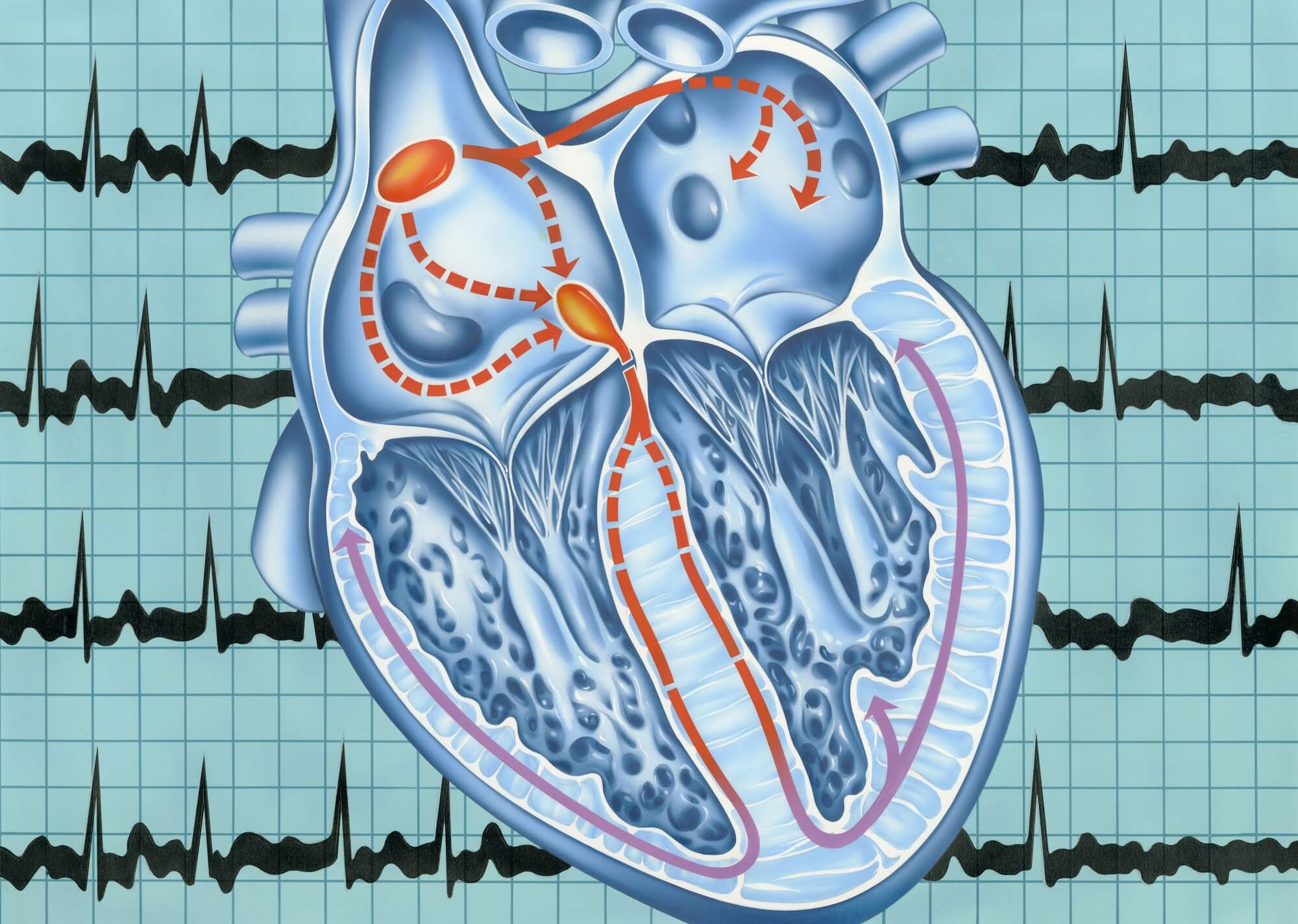 atrial-fibrillation-risk-increased-for-antidepressant-users-prior-to