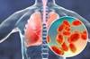 Bacterial Pneumonia Associated With Increased Risk for Future MACE Bacterial Pneumonia Associated With Increased Risk for Future MACE