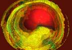Ezetimibe Plus Statin Therapy Reduces Ischemic Risk in Polyvascular Disease, T2D Ezetimibe Plus Statin Therapy Reduces Ischemic Risk in Polyvascular Disease, T2D