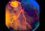 Icosapent Ethyl Reduces Ischemic Event Risk in Patients With Hypertriglyceridemia Despite Statin Use Icosapent Ethyl Reduces Ischemic Event Risk in Patients With Hypertriglyceridemia Despite Statin Use