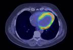 AHA: Dapagliflozin Noninferior to Placebo for MACE in T2DM AHA: Dapagliflozin Noninferior to Placebo for MACE in T2DM