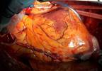 CABG Vein Harvesting Techniques Have Similar MACE Risks CABG Vein Harvesting Techniques Have Similar MACE Risks
