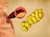 Antisense Drug Can Safely and Effectively Reduce Elevated Lipoprotein(a) Antisense Drug Can Safely and Effectively Reduce Elevated Lipoprotein(a)