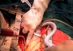 Chronic CCB Therapy Linked to Improved Outcomes After CABG Utilizing the Radial Artery Chronic CCB Therapy Linked to Improved Outcomes After CABG Utilizing the Radial Artery