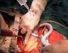 Chronic CCB Therapy Linked to Improved Outcomes After CABG Utilizing the Radial Artery Chronic CCB Therapy Linked to Improved Outcomes After CABG Utilizing the Radial Artery