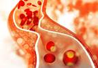 Total CV Event Reduction More Effectively Assesses Alirocumab Efficacy After ACS Total CV Event Reduction More Effectively Assesses Alirocumab Efficacy After ACS