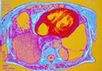 ACC Releases Consensus Decision Pathway for CVD Risk Reduction in T2D and ASCVD ACC Releases Consensus Decision Pathway for CVD Risk Reduction in T2D and ASCVD