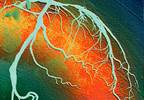 Healthy Lifestyle Tied to Reduced Atherosclerosis in Women Healthy Lifestyle Tied to Reduced Atherosclerosis in Women