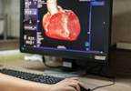 First-in-Human Telerobotic Percutaneous Coronary Intervention Successful First-in-Human Telerobotic Percutaneous Coronary Intervention Successful
