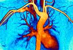 Ezetimibe Plus Statins Modestly Reduce Cardiovascular Disease Event Risk Ezetimibe Plus Statins Modestly Reduce Cardiovascular Disease Event Risk