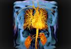 Sustained Improvements in CVD Risk With Intensive T2D Intervention Sustained Improvements in CVD Risk With Intensive T2D Intervention