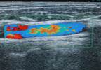 Ultrasound-Based Visualization of Silent Atherosclerosis May Improve Medication Adherence Ultrasound-Based Visualization of Silent Atherosclerosis May Improve Medication Adherence