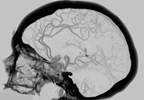 What Is the Optimal Revascularization Strategy in Patients With Cerebrovascular Disease? What Is the Optimal Revascularization Strategy in Patients With Cerebrovascular Disease?