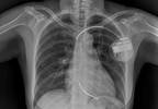 Do More Aggressive Periprocedural Antibiotic Regimens Reduce Risk of Device-Related Infections? Do More Aggressive Periprocedural Antibiotic Regimens Reduce Risk of Device-Related Infections?