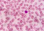 2010 to 2014 Saw Increase in Anemia After Hospitalization 2010 to 2014 Saw Increase in Anemia After Hospitalization
