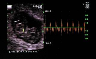 No increased risk observed for congenital malformations but a small increased risk seen for oral clefts. No increased risk observed for congenital malformations but a small increased risk seen for oral clefts.