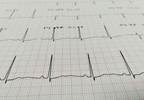 Artificial Intelligence Can Use Routine ECGs to Identify Heart Disease Artificial Intelligence Can Use Routine ECGs to Identify Heart Disease
