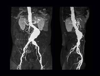 People at increased risk include those with a history of aortic aneurysms and hypertension. People at increased risk include those with a history of aortic aneurysms and hypertension.