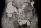 Hospitalization for Upper GI Bleed Highest With Rivaroxaban Hospitalization for Upper GI Bleed Highest With Rivaroxaban