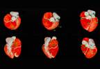 Can You Safely Shift Lower Risk Patients to CCTA When Evaluating Suspected Stable CAD? Can You Safely Shift Lower Risk Patients to CCTA When Evaluating Suspected Stable CAD?