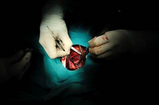Overall long-term transplant-free survival in repaired Tetralogy of Fallot is favorable. Overall long-term transplant-free survival in repaired Tetralogy of Fallot is favorable.