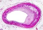 High-Intensity Statins Affect Coronary Plaque Composition After STEMI High-Intensity Statins Affect Coronary Plaque Composition After STEMI