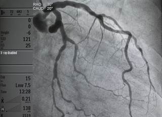 After nicardipine treatment, all vessels showed TIMI 3 flow and TFC <28. After nicardipine treatment, all vessels showed TIMI 3 flow and TFC <28.