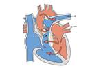 Macitentan Not Superior to Placebo for Improving Exercise Capacity in Eisenmenger Syndrome Macitentan Not Superior to Placebo for Improving Exercise Capacity in Eisenmenger Syndrome