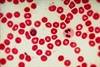 Elevated Red Cell Distribution Width Associated With Pulmonary Hypertension Elevated Red Cell Distribution Width Associated With Pulmonary Hypertension