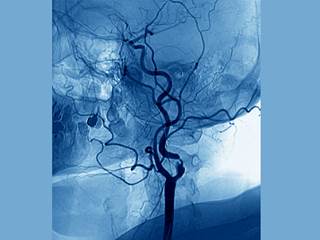 Researchers gauged incidence of new or worsened stroke, intracranial hemorrhage, and death as main complications of patients with moderate to severe strokes who underwent urgent carotid intervention. Researchers gauged incidence of new or worsened stroke, intracranial hemorrhage, and death as main complications of patients with moderate to severe strokes who underwent urgent carotid intervention.