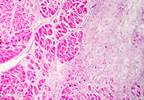 Infection and Infarction: Cause and Effect? Infection and Infarction: Cause and Effect?