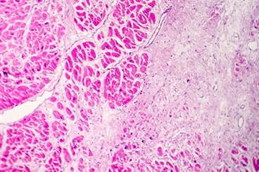 Infection and Infarction: Cause and Effect? Infection and Infarction: Cause and Effect?