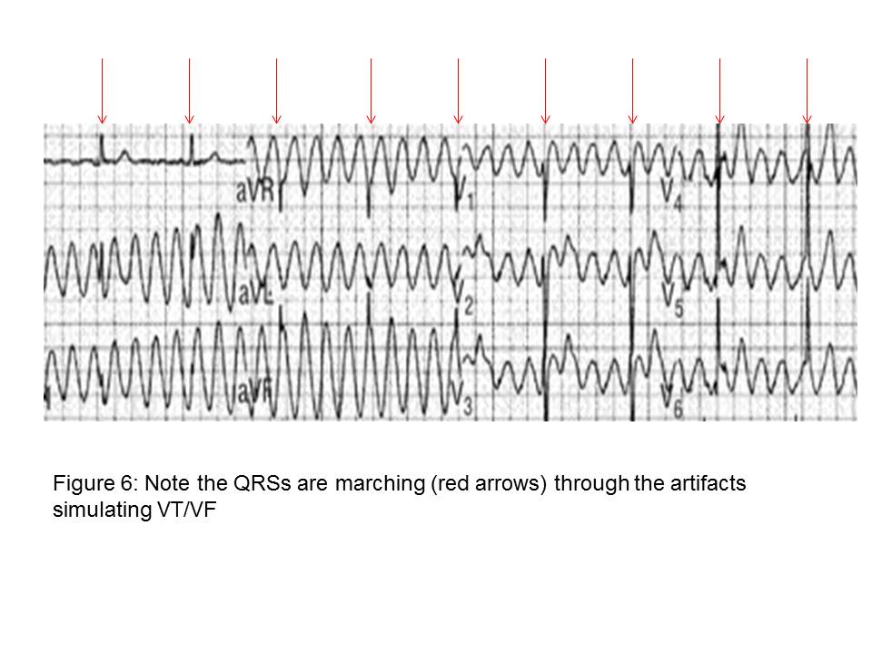 Treatment of Ventricular Arrhythmias