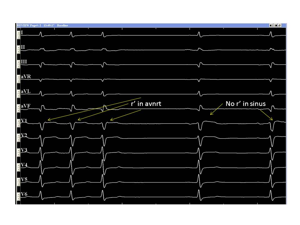 AV nodal reentrant tachycardia: Diagnosis and Treatment