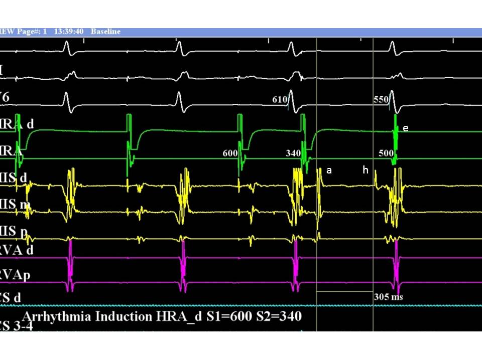 AV nodal reentrant tachycardia: Diagnosis and Treatment