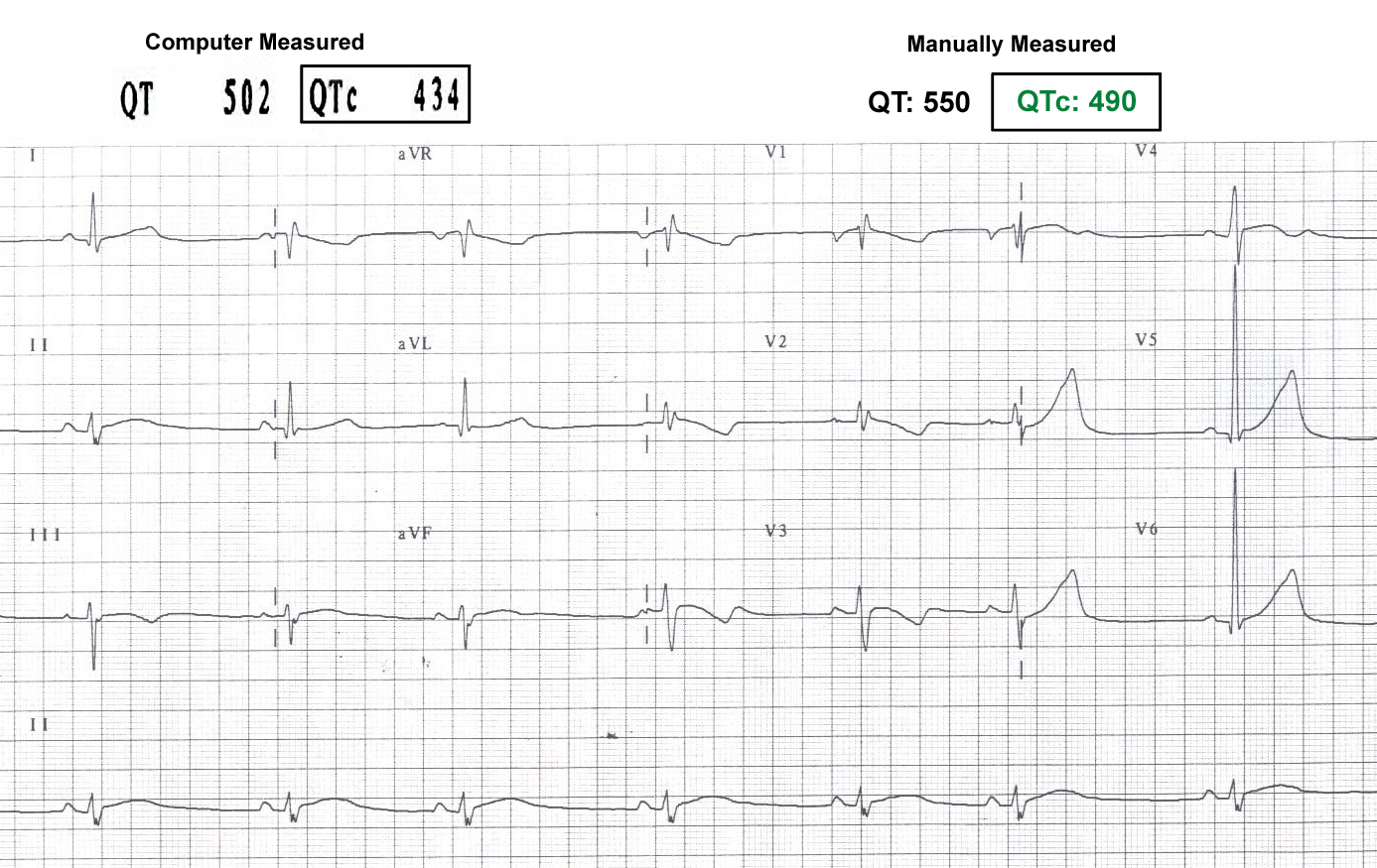 Lethal dose of propranolol qt