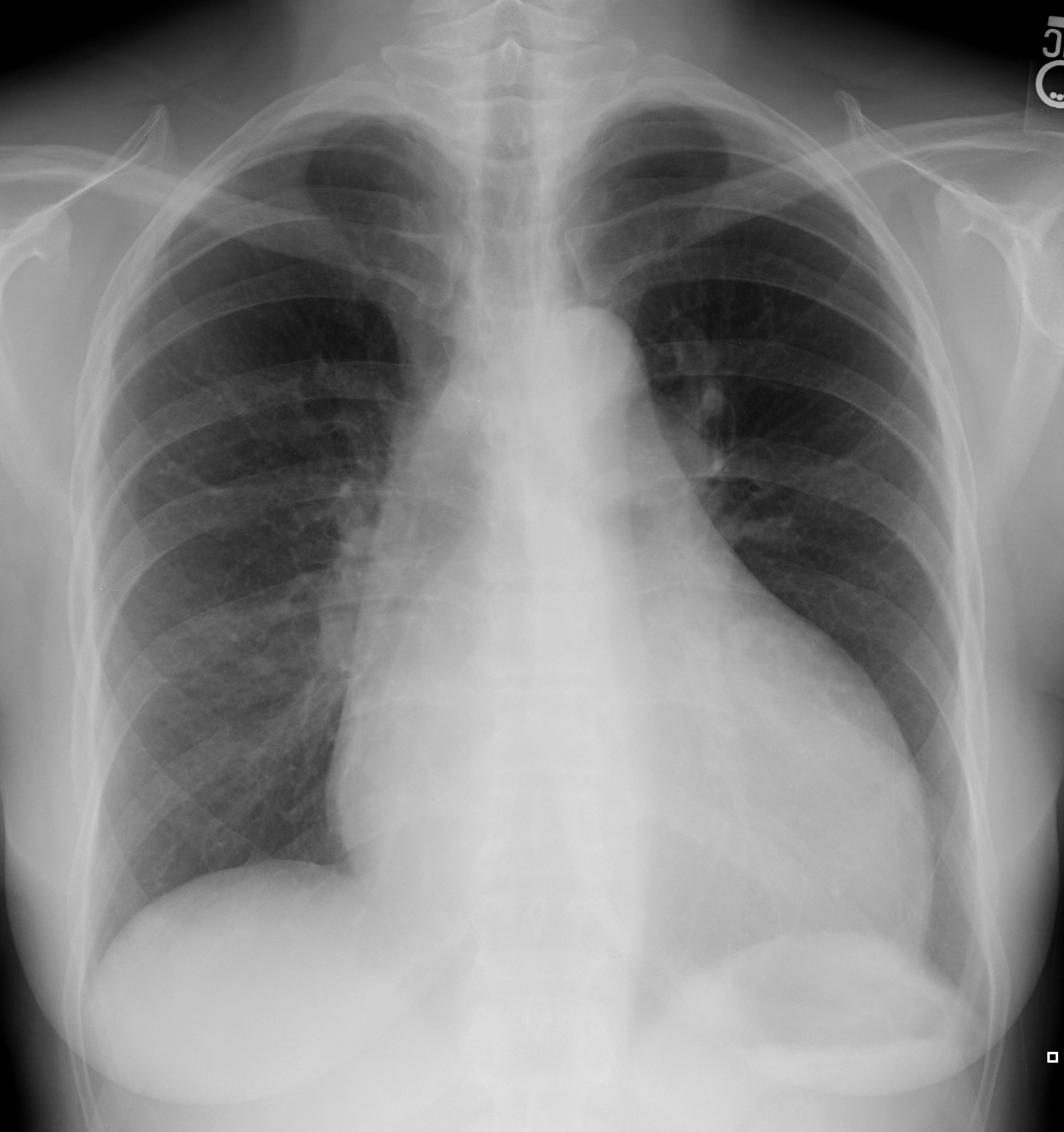 Diagnosing and Classifying Pulmonary Hypertension