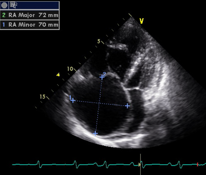 3 Hypertension