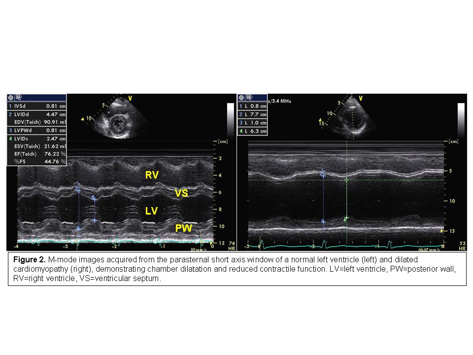 Use of the Echocardiogram to Define the Presence, Extent, and Etiology of Cardiac Dysfunction